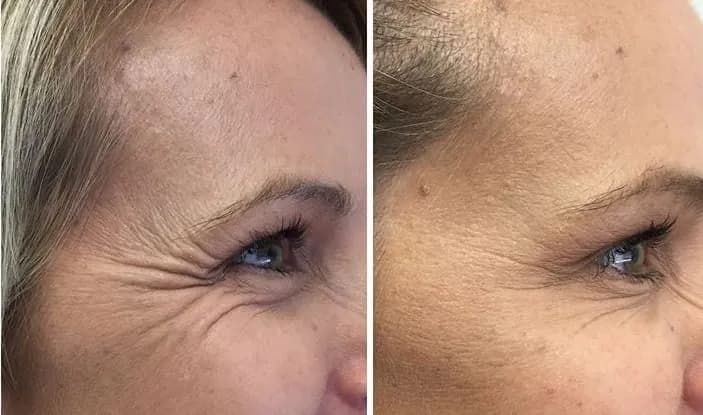 Botoks czy warto? Poznaj prawdę o efektach i ryzyku zabiegu