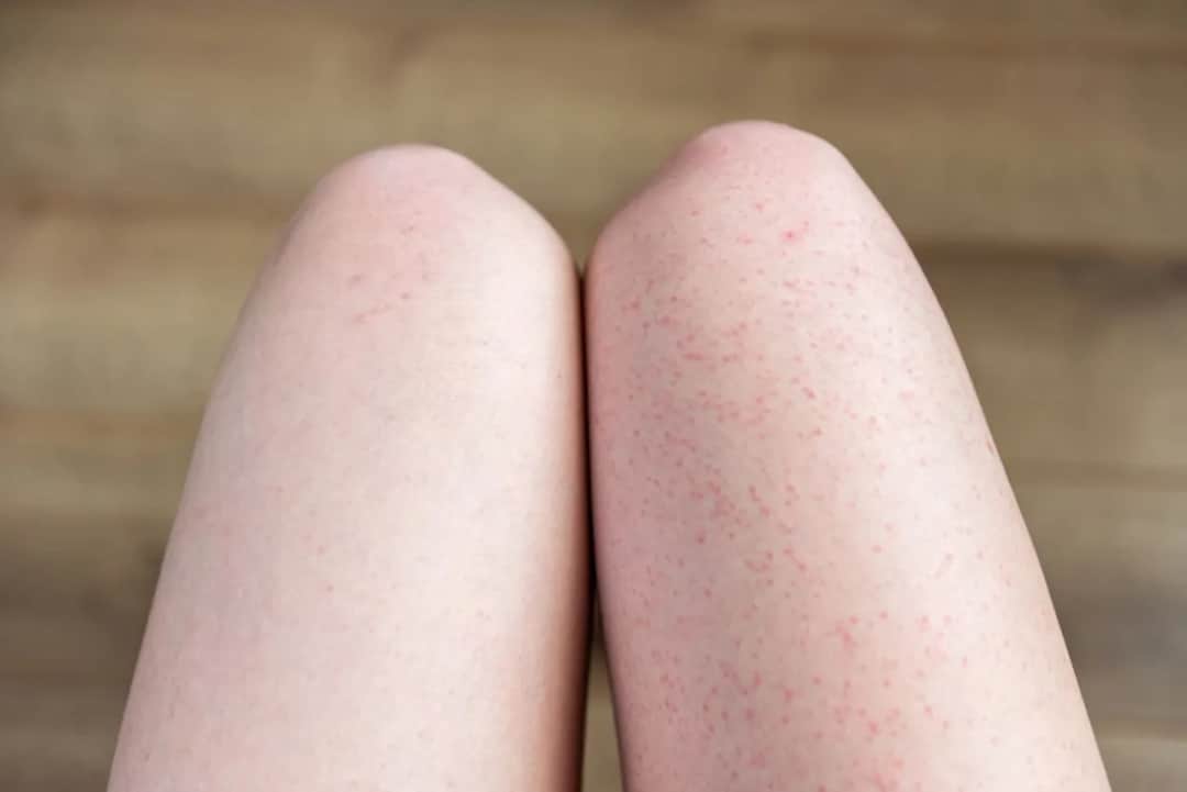 Czerwone kropki po goleniu nóg - dlaczego się pojawiają i jak ich uniknąć
