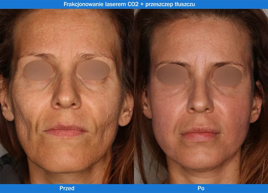 Jak często stosować laser frakcyjny, aby uniknąć rozczarowania?