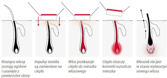 Jak działa depilator laserowy? Poznaj skuteczną metodę depilacji