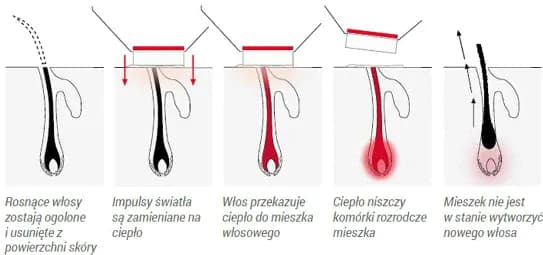 Jak działa depilator laserowy? Poznaj skuteczną metodę depilacji