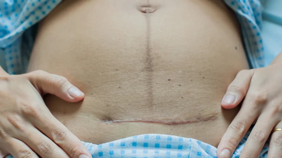 Kiedy można się golić po cesarce? Kluczowe informacje dla mam