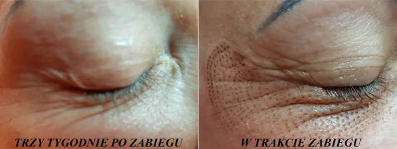 Laserowe wygładzanie zmarszczek - skuteczna metoda odmładzania skóry