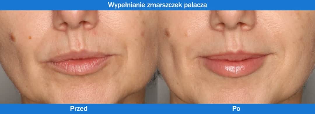 Zmarszczki palacza: Botox czy kwas hialuronowy - co wybrać?
