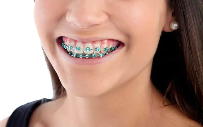 Czy aparat na zęby powiększa usta? Odkryj prawdę o zmianach w wyglądzie