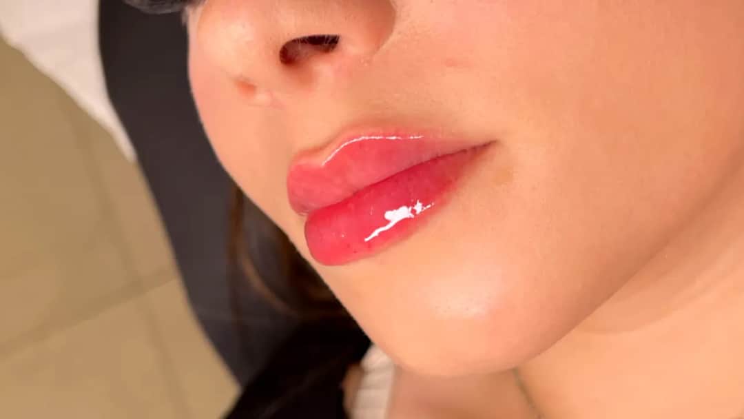 Powiększanie ust Radom - gdzie najlepiej znaleźć renomowane kliniki?